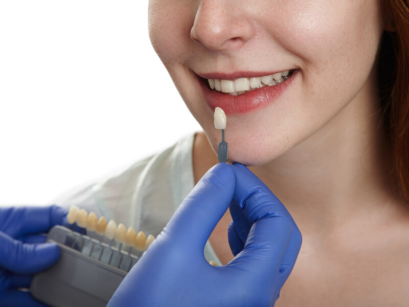 are dental veneers worth it benefits, risks, and long-term value