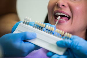Why Dental Veneers Are the Key to Your Dream Smile