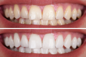How One-Visit Teeth Whitening Can Transform Your Smile