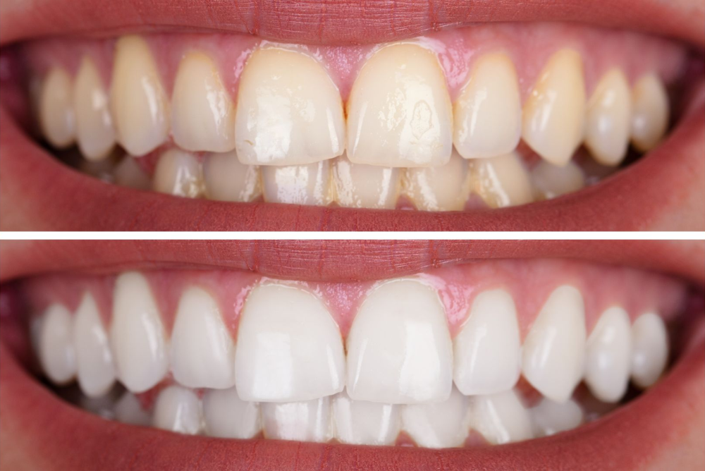 How One-Visit Teeth Whitening Can Transform Your Smile