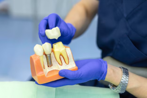 Looking for dental implants in Kennesaw? We provide reliable, long-lasting dental implants near you to restore your smile, confidence, and oral function. Book today.