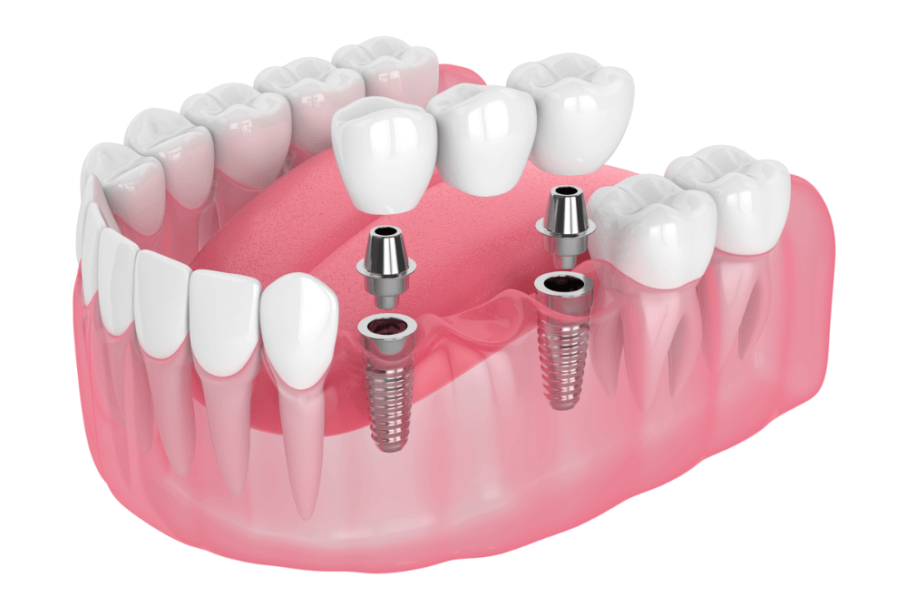How Dental Crowns & Bridges Help Protect Your Oral Health