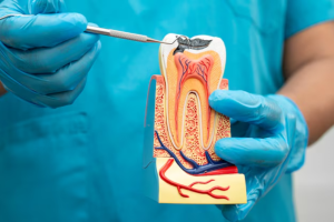 Root canal therapy in Kennesaw removes infection from inside the tooth to relieve pain. Visit for professional root canal therapy near you.