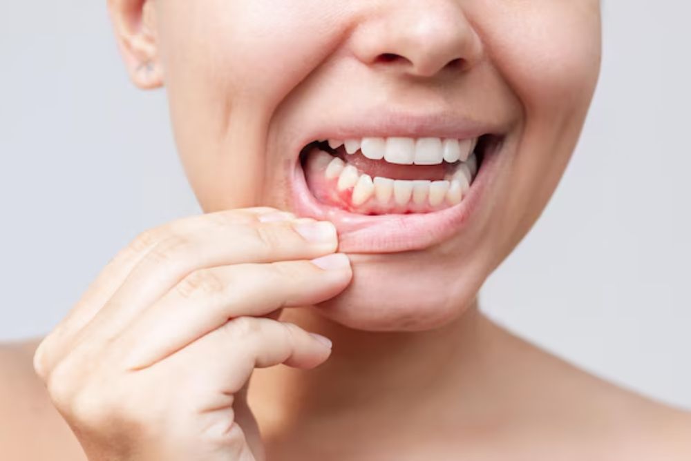 what-nutrients-are-needed-for-gum-health
