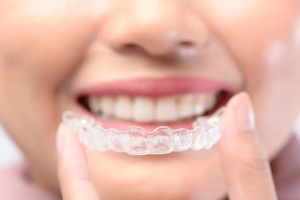 What Is The 30-Minute Rule With Invisalign?