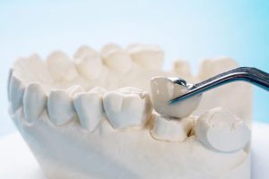 dental crown placement on a prepared tooth for restoring strength and function