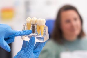 Dental Implant Model Demonstrating Permanent Tooth Replacement And Restoration Benefits