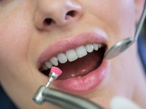 how do dentists fix minor chips in teeth